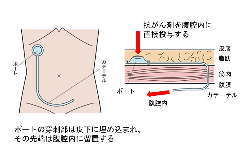 腹腔内ポート