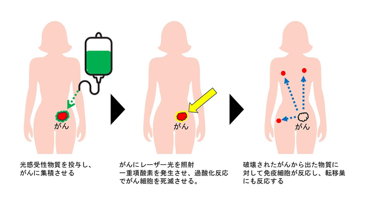 光がん免疫治療法とは